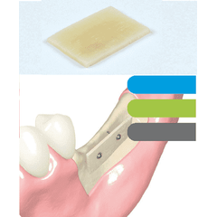 Максграфт Кортіко аллогенова кісткова пластина (maxgraft cortico), Упаковка: 1 шт